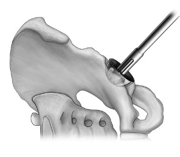 ABORDAJE Y EXPOSICIÓN Esta técnica quirúrgica presupone que el paciente está posicionado en decúbito lateral.