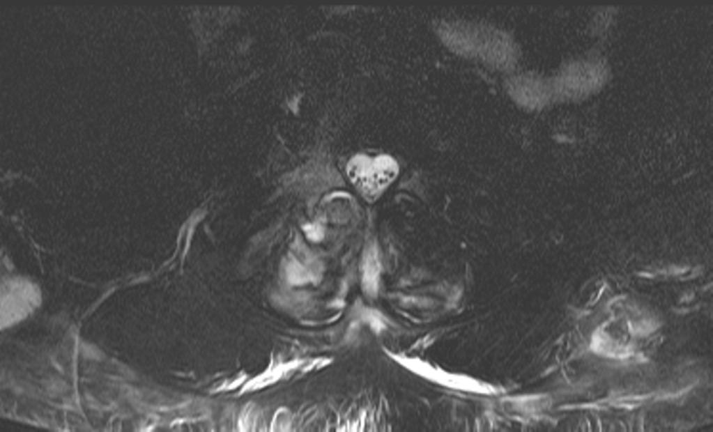 Fig. 8: RM axial potenciada en T2 con supresión grasa, en la que se aprecian los abscesos glúteos bilaterales, el engrosamiento de la articulación posterior derecha, con líquido interarticular que
