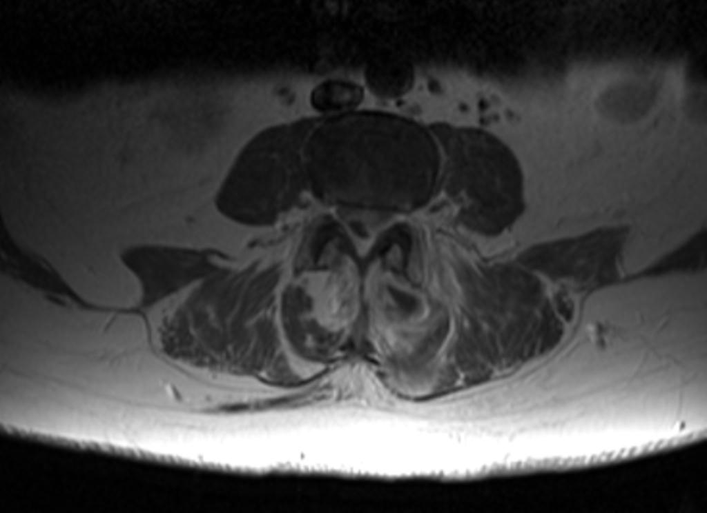 Fig. 18: RM axial T1 con Gadolínio, observando la captación de las articulaciones posteriores y del absceso paravertebral posterior izquierdo.