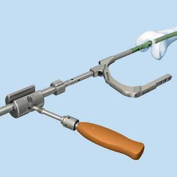 Abordaje retrógrado: Inserción del clavo Si se requieren más fuerzas de inserción, acople la guía corredera a la pieza de conexión y utilice el martillo en modo de deslizamiento.