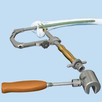 Abordaje retrógrado: Bloqueo con hoja espiral (optional) Golpee de forma suave y controlada con el martillo combinado en posición fija para asentar la hoja espiral.