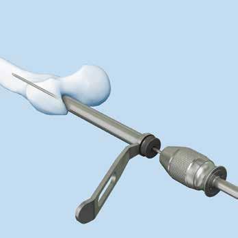 Abordaje anterógrado Apertura del fémur proximal Introduzca la guía de broca en la vaina de protección hística. Introduzca el conjunto a través de la incisión hasta el hueso.