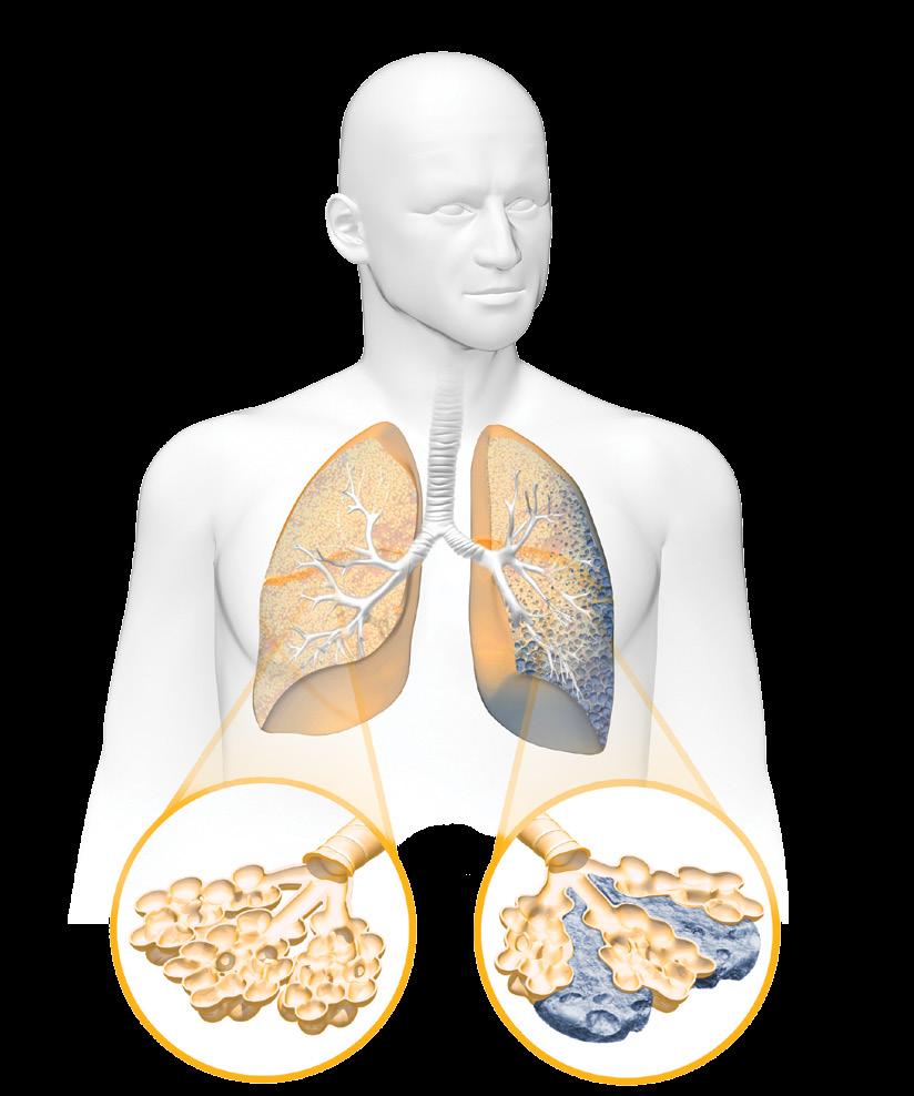 Entienda cómo le afecta la IPF La fibrosis pulmonar idiopática (Idiopathic Pulmonary Fibrosis, IPF) es una enfermedad grave que hace que se forme tejido cicatricial en los pulmones de