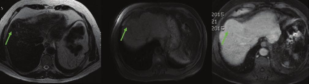 LI-RADS 2 LI-RADS 3 (FIGURA 8) Son lesiones probablemente benignas, similares al LR1, y su diagnóstico depende de la certeza del radiólogo: Quistes Hemangiomas Anomalías vasculares Área focal de