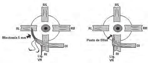 medios y plegamiento de rectos laterales según el ángulo de esotropía. Todos mostraron un aumento de la desviación vertical en la lateroversión opuesta de cada ojo.