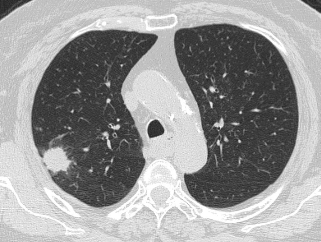 Fig. 9: Nódulo pulmonar en paciente