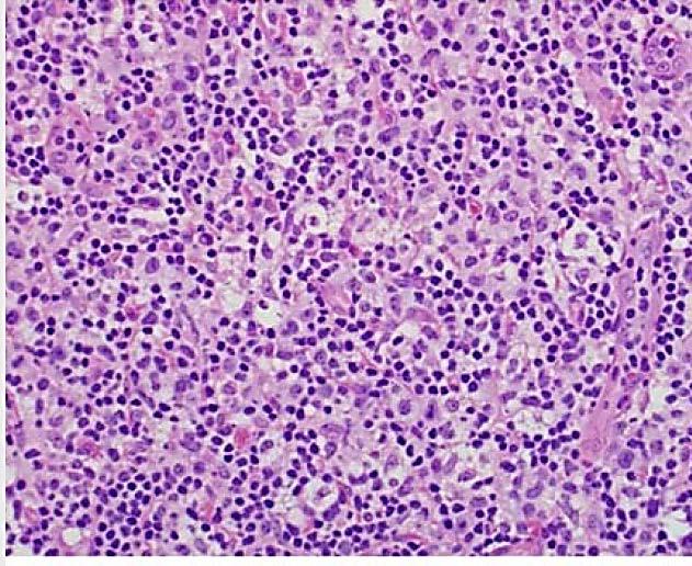 VARIANTE LINFOHISTIOCITICA Rara (5-20%) Patrón Lennertoide= gran cantidad de macrófagos y linfocitos Porcentaje relativo pequeño de células neoplásicas Células hallmark identificadas Zonas