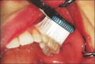 La técnica de cepillado dental de Charters se ha recomendado para pacientes con recesión gingival o en casos post cirugía periodontal.