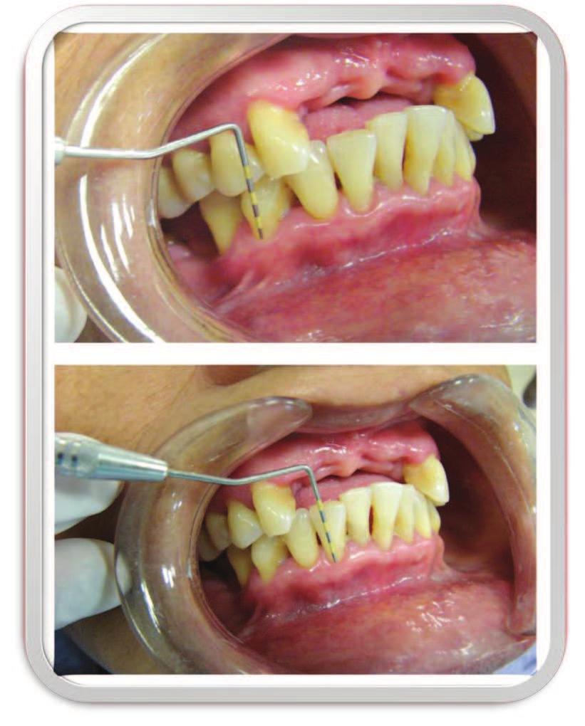 Medición de Recesión Gingival Post-Tratamiento periodontal Fuente: