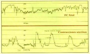 ANTICIPACIÓN Registro cardiotocográfico FC basal: 120-160 lpm