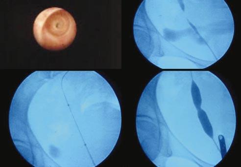 774 E. Pérez-Castro, J. I. Iglesias Prieto, J. Vicente Rodríguez y cols. FIGURA 7. Imagen ureteroscópica de estenosis ureteral en ureter pelviano.