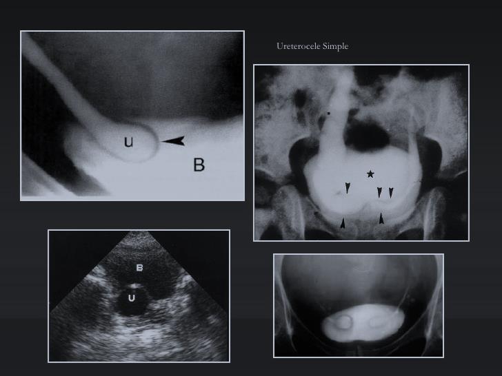 Ureterocele Dilatación quística del segmento intravesical del