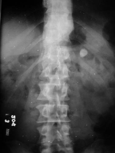 Técnica de Infusión: o Abandonada: mayor dosis, peor imagen. 4. Radiografía simple preliminar de reconocimiento: Verificar preparación del paciente: que no haya materia fecal.