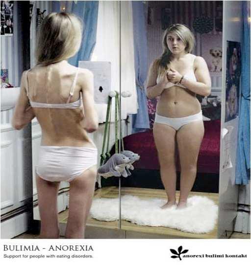 Bulimia Nerviosa Definición Episodios de atracones incontrolados de cantidad variable de comida,