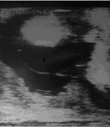 Gestación de 6 meses en búfala de Río: placentoma (1), pared uterina (2)./ Six month pregnancy in water buffaloes: placentoma (1), uterine wall (2).