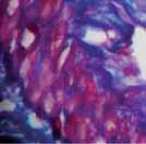 Semilunas celulares Adherencias fibrosas Atrofia tubular