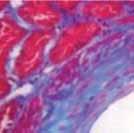 Prevalencia y correlación clinicopatológica de lesiones vasculares renales en la nefropatía por IgA Figura 9. Fibrosis intimal moderada. T. Masson, 100X. Figura 10. Fibrosis intimal severa. PAS, 200X.