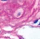 El único caso con proteinuria leve, función renal conservada, TAS y TAD normales, correspondió a una mujer de 42 años, cuya BR mostró un GH II y oclusión trombótica de una arteriola, cuya causa no se