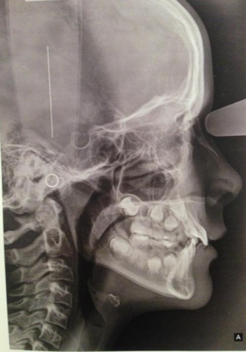 15 2.1.1. Radiografía cefálica lateral de cráneo Ilustración 1: Radiografía lateral de cráneo (Fernandez, 2009) La radiografía cefálica lateral de cráneo es una radiografía que muestra una imagen