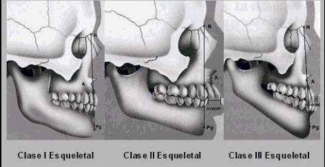27 Ilustración 3: Características de las clases esqueletales I, II y III (Villanueva, 2009) 2.6.