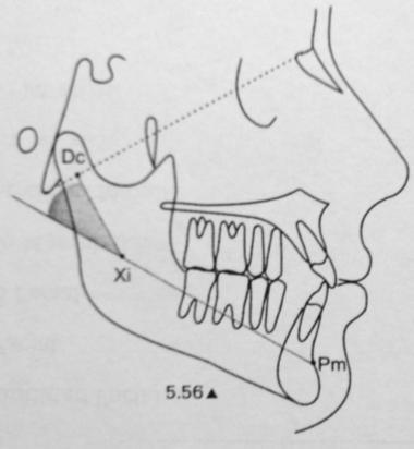 33 E. Arco Mandibular: Es la medida angular entre el eje del Cuerpo, Xi Pm, y el eje condilar, Xi- Dc. Este ángulo describe la forma de la mandíbula.