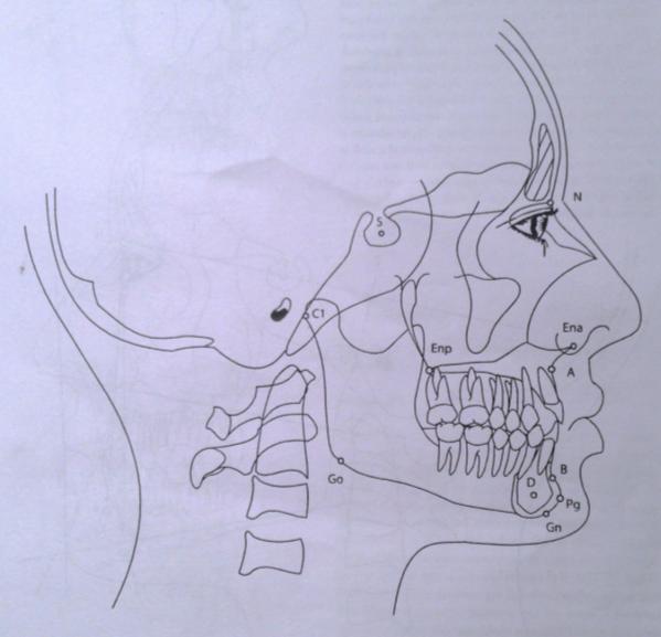 36 Punto B: Es el punto más posterior, sobre la curvatura anterior de la mandíbula, se sitúa verticalmente entre Pogonion y el reborde alveolar.