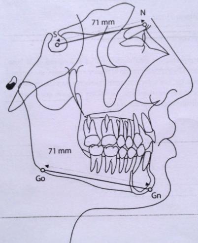 41 Ilustración 16: Relación del cuerpo mandibular con la base craneal anterior. (Zamora, 2010) 3. Método de estudio 3.1. Tipo de estudio Es un estudio comparativo ya que compara los resultados de los análisis cefalómetricos con las normas establecidas por varios autores.