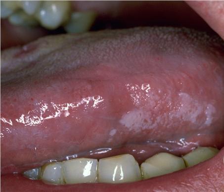 seborreica, psoriasis Mucosa oral: muguet, leucoplasia