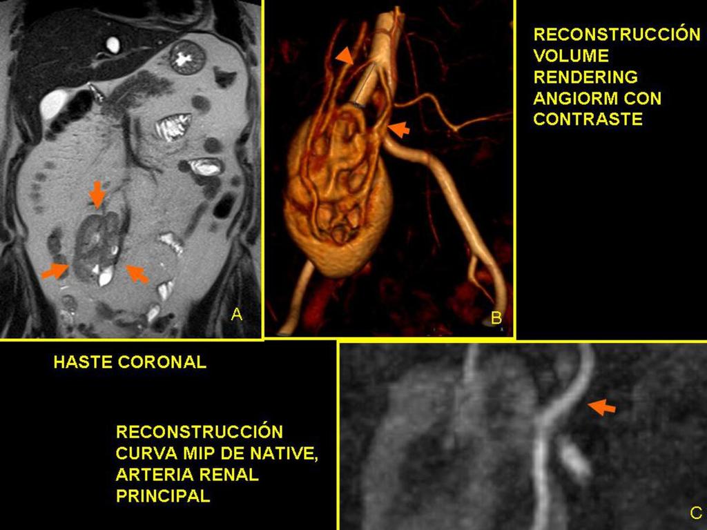 Fig. 23: Riñón ectópico pélvico: Paciente remitido para estudio del mapa vascular de riñón derecho ectópico. A: En la imagen HASTE coronal se observa riñón ectópico y malrotado (flechas).