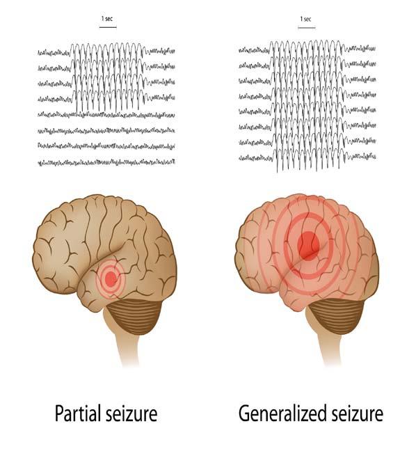 CLASIFICACIÓN SEGÚN EXTENSIÓN DEL COMPROMISO NEUROLÓGICO Crisis parciales Producidas x descargas eléctricas anormales en focos epileptogenos limitados a una región de la corteza cerebral
