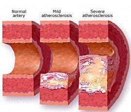 La Arterioesclerosis es una enfermedad en la que las plaquetas se acumulan dentro de las arterias.