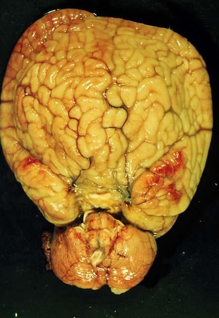 Fig. 1. Fotografía del cerebro holoprosencefálico. Vista ventral.