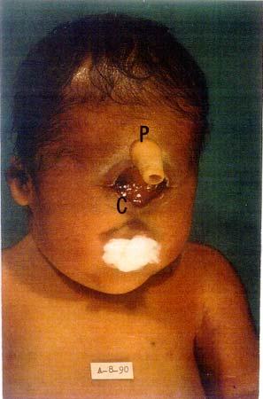 Fig.3 Recién nacido con holoprosencefalia.