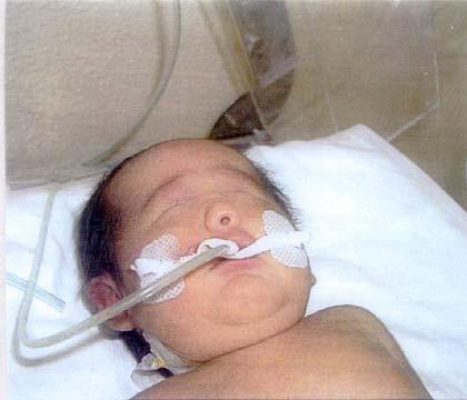 Fig. 4 fotografía de un recién nacido con Cebocefalia.
