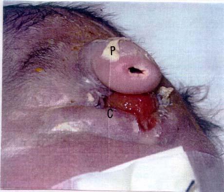 Fig. 12. Fotografía de un recién nacido con ciclopia y holoprosencefalia semilobar.