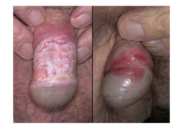 Infecciones de la vagina o de la vulva pueden causar picazón grave, ardor, dolor, irritación y una descarga blanquecina o blanco grisáceo