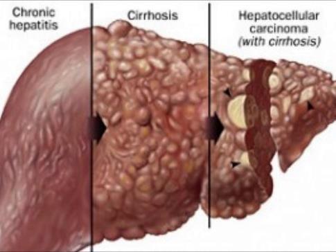 La hepatitis hace que el hígado se inflame y deje de funcionar correctamente.