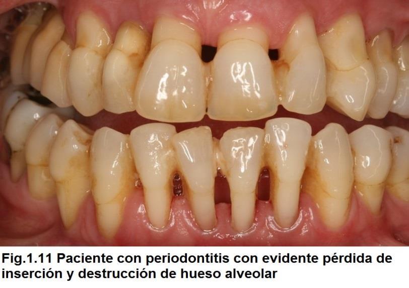 Periodontitis I.