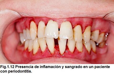 Recesión gingival La recesión y exposición radicular pueden estar presentes o no en la periodontitis crónica.