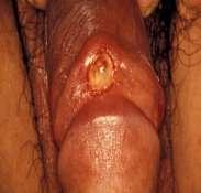 Sífilis primaria Penetra a través de piel y mucosas (Intacta o con abrasiones) Período de incubación
