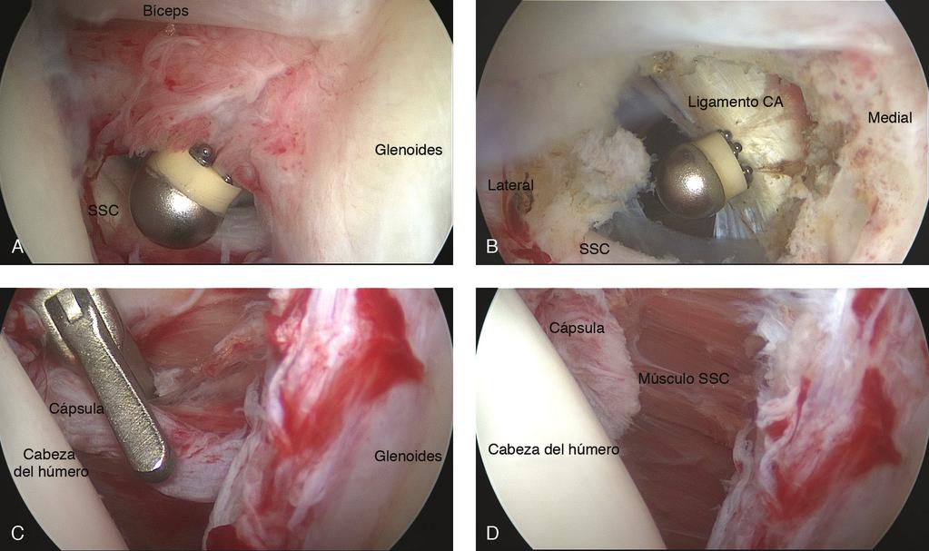 Sección Figura 2 Imagen de artroscopia del hombro izquierdo tal y como se ve durante la liberación quirúrgica.