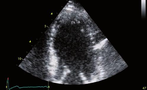 Bases de los ultrasonidos en ecocardiografía 01 A B Figura 1.3. Concepto físico de la imagen armónica Vídeo 1.4.