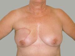 Indicaciones para el tratamiento conservador de la mama (TCM): - Carcinoma ductal in situ (Estadio precanceroso: CDIS = localizado en los ductos; CLIS = localizado en los lóbulos) - Carcinoma