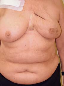 Mamas de diferente tamaño tras la operación A menudo la extirpación del tumor ocasiona una asimetría entre las mamas.