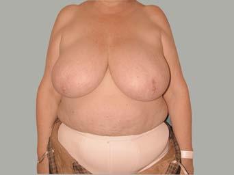 con extirpación total del tumor en la mama afectada - cirugía plástica de reducción en la mama sana para igualar la óptica 1. Paciente (55) con tumor en el cuadrante superior izquierdo.