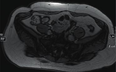 sesión C. Reducción de la grasa en la zona abdominal inferior medida en las imágenes tomadas por resonancia magnética4 13.3mm 18.