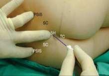 2) Punción vascular. 3) Inyección intratecal. 4) Inyección intraóseasubperióstica.
