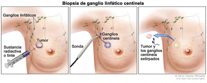 La biopsia de ganglios linfáticos centinela es un tipo de cirugía en la que el cirujano extirpa unos cuantos ganglios linfáticos para examinarlos.
