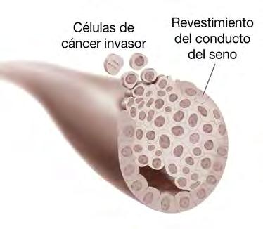 Las opciones de tratamiento para el CDIS son: Tumorectomía. Este es un tipo de cirugía conservadora del seno o cirugía para preservar el seno. Generalmente se da seguimiento con radioterapia.