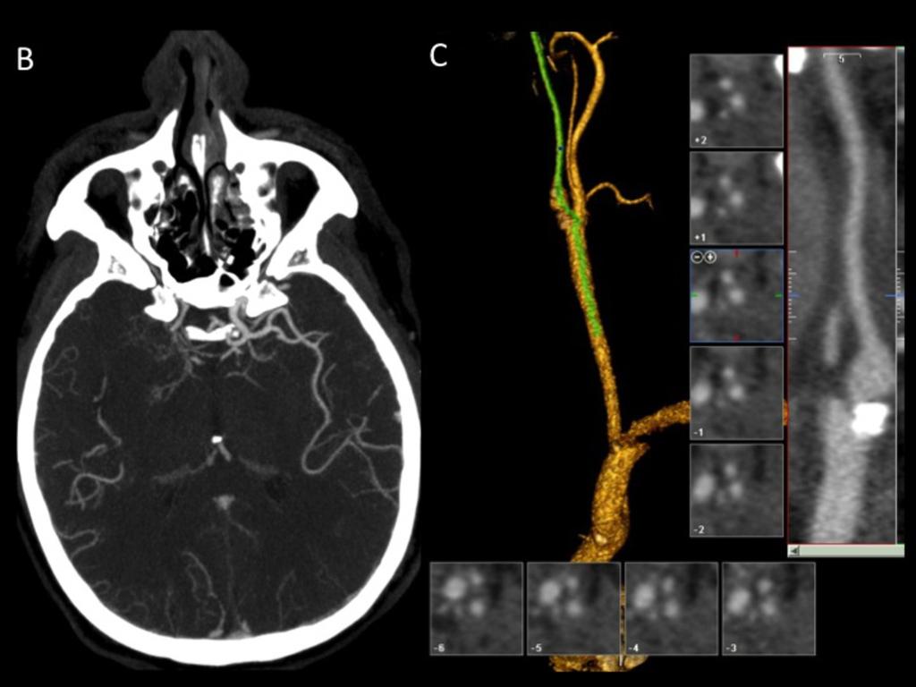 Fig. 12: El estudio angiografico mediante TC muestra una estenosis preoclusiva en el origen de la ACI derecha, causada por una placa parcialmente calcificada (C), así como una oclusión de
